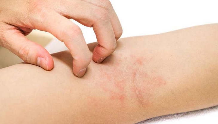 অ্যালার্জির সমস্যায় ভুগছেন? জেনে নিন মুক্তির উপায়