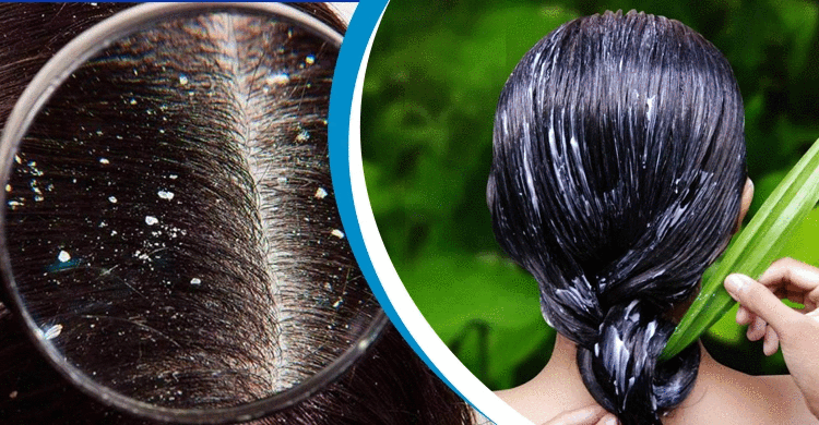 খুশকি দূর করার সহজ ৩ উপায়