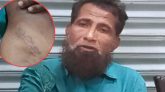 হাতভাঙা রোগীর কিডনি অপসারণ : অভিযোগ তদন্তে ৫ সদস্যের কমিটি
