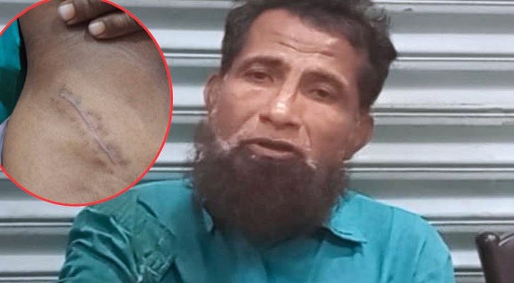 হাতভাঙা রোগীর কিডনি অপসারণ : অভিযোগ তদন্তে ৫ সদস্যের কমিটি
