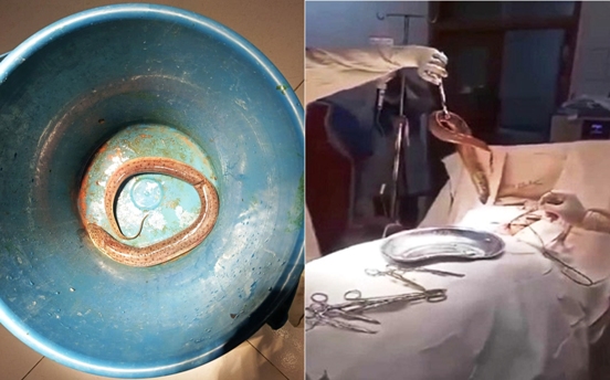 ওসমানী হাসপাতালে পেট কেটে বের করা হলো জীবন্ত কুঁচিয়া মাছ!