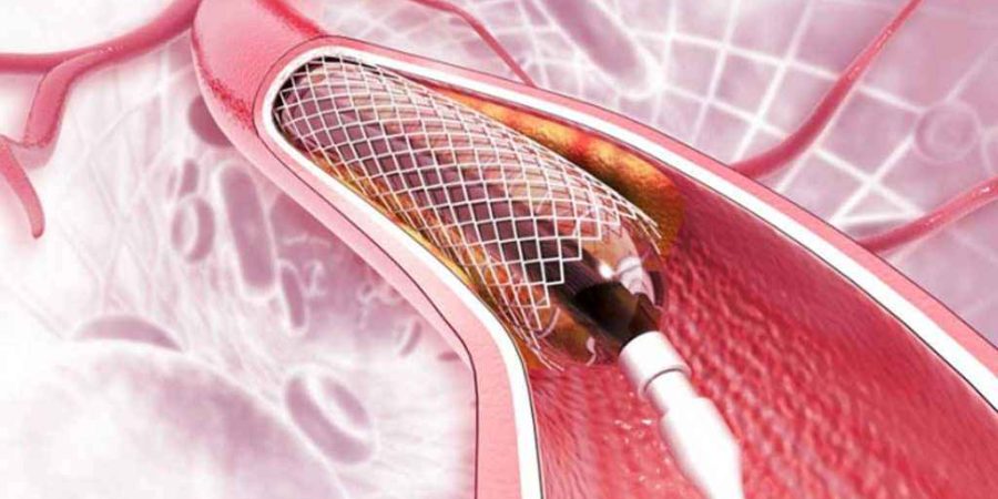 হার্টের রিংয়ের দাম কমালো সরকার