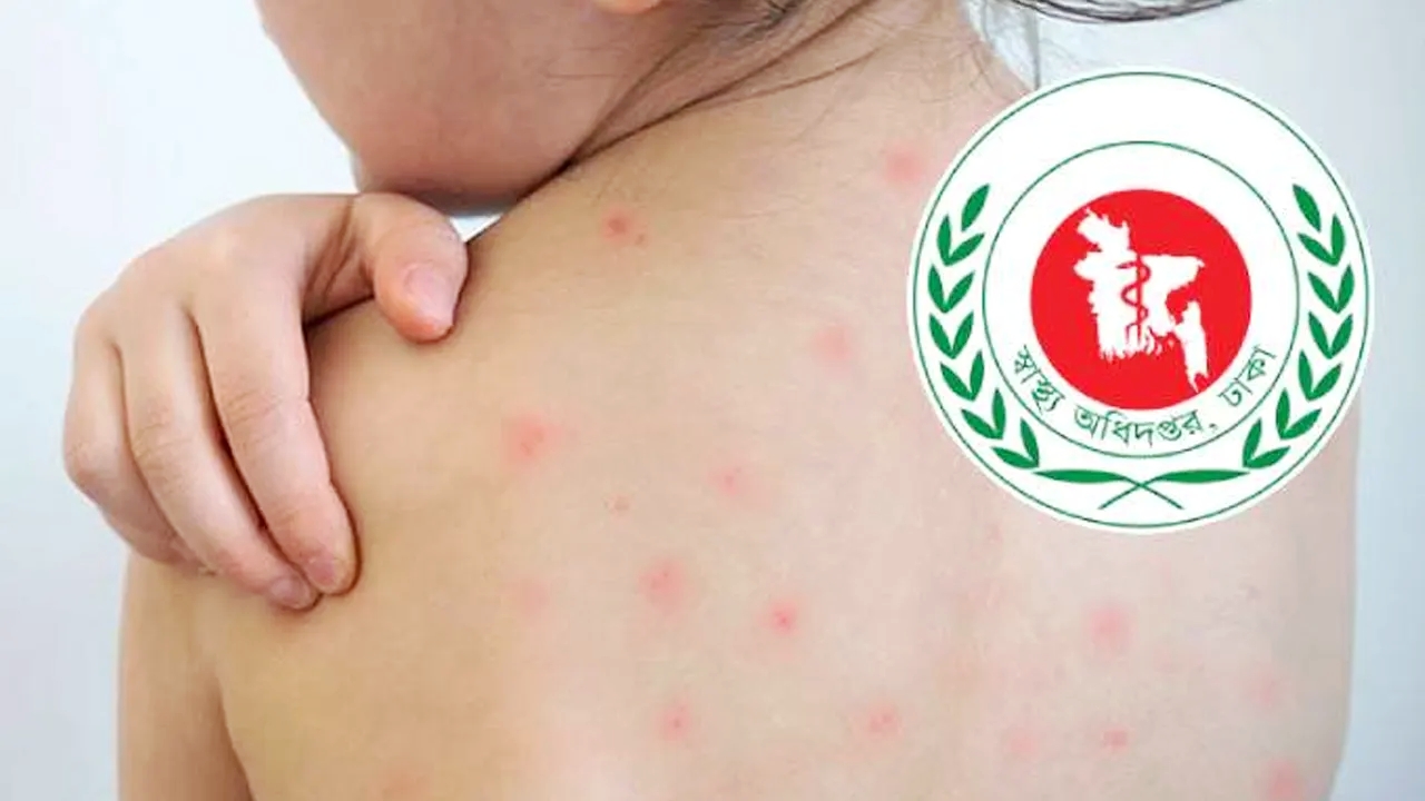 হামের উপসর্গে আরও ৩ শিশুর মৃত্যু