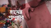 হাম ও উপসর্গে বাড়ছে মৃত্যু, ২৪ ঘণ্টায় ৭ প্রাণহানি